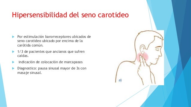hipersensibilidad del seno carotideo